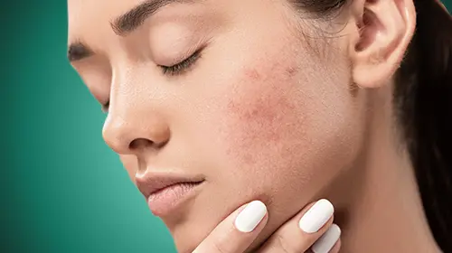 A close-up of a woman with her eyes closed gently touching her chin, showing visible acne and redness on her cheek against a green background.